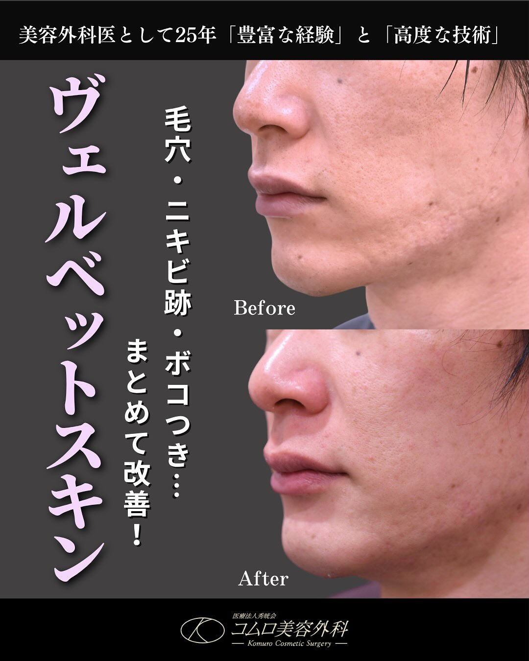 【ヴェルヴェットスキン症例✨】