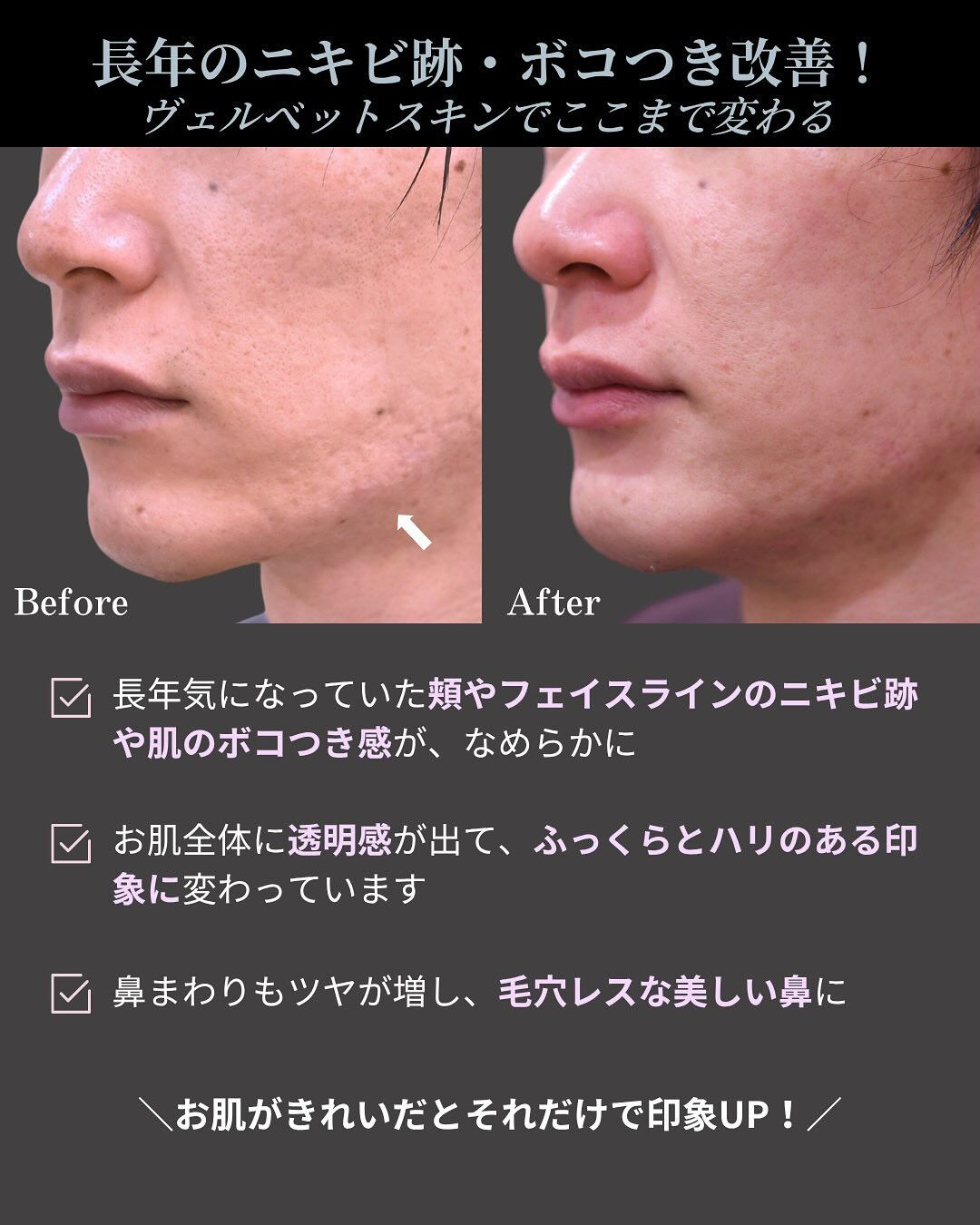 【ヴェルヴェットスキン症例✨】