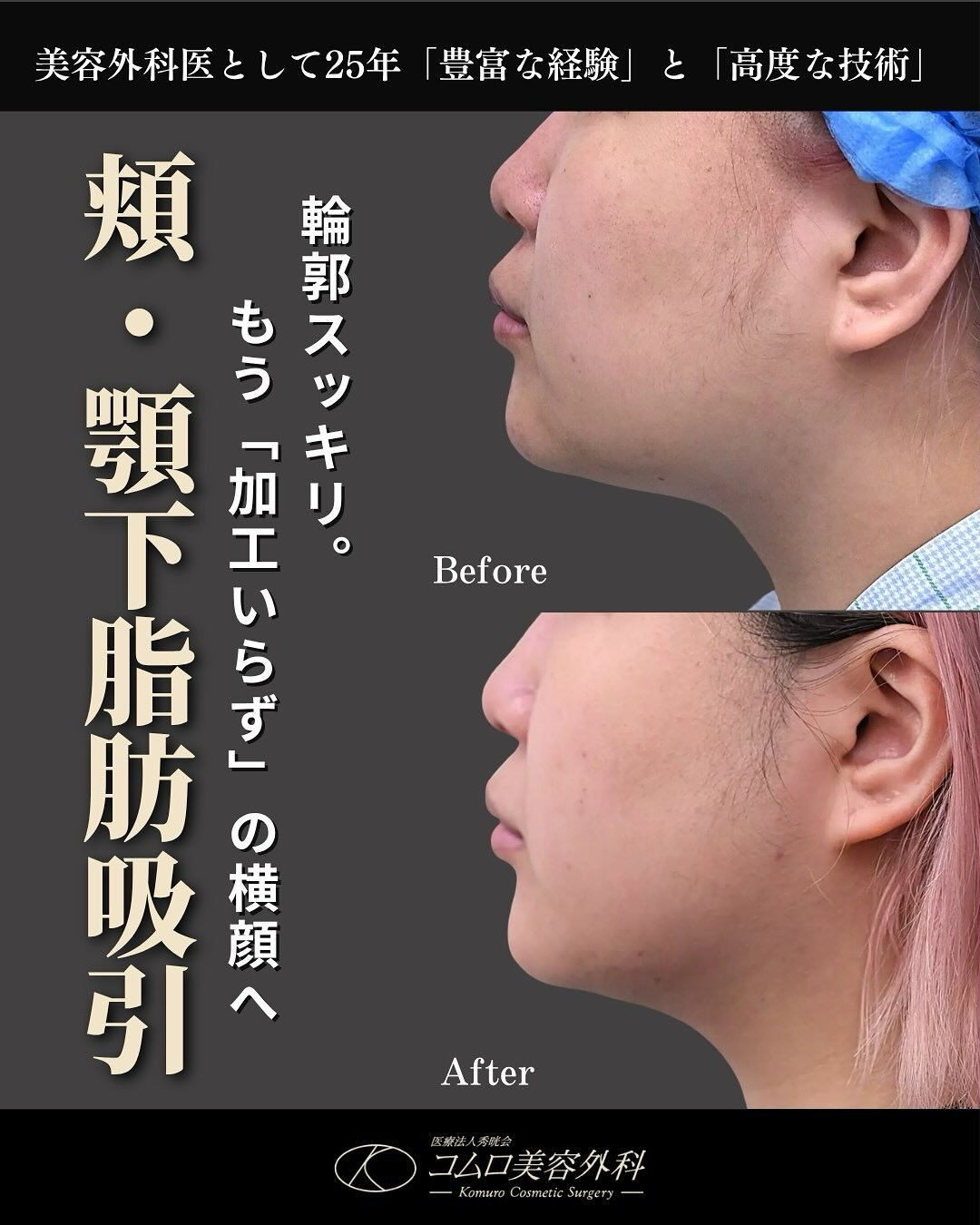 【頬・顎下脂肪吸引】