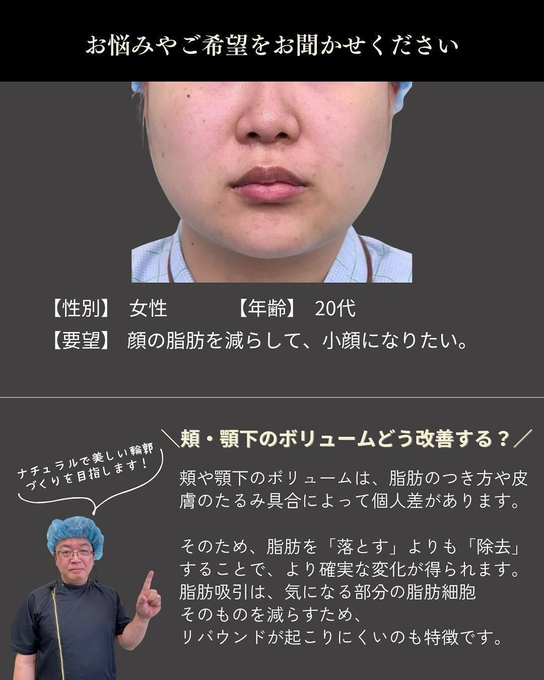 【頬・顎下脂肪吸引】