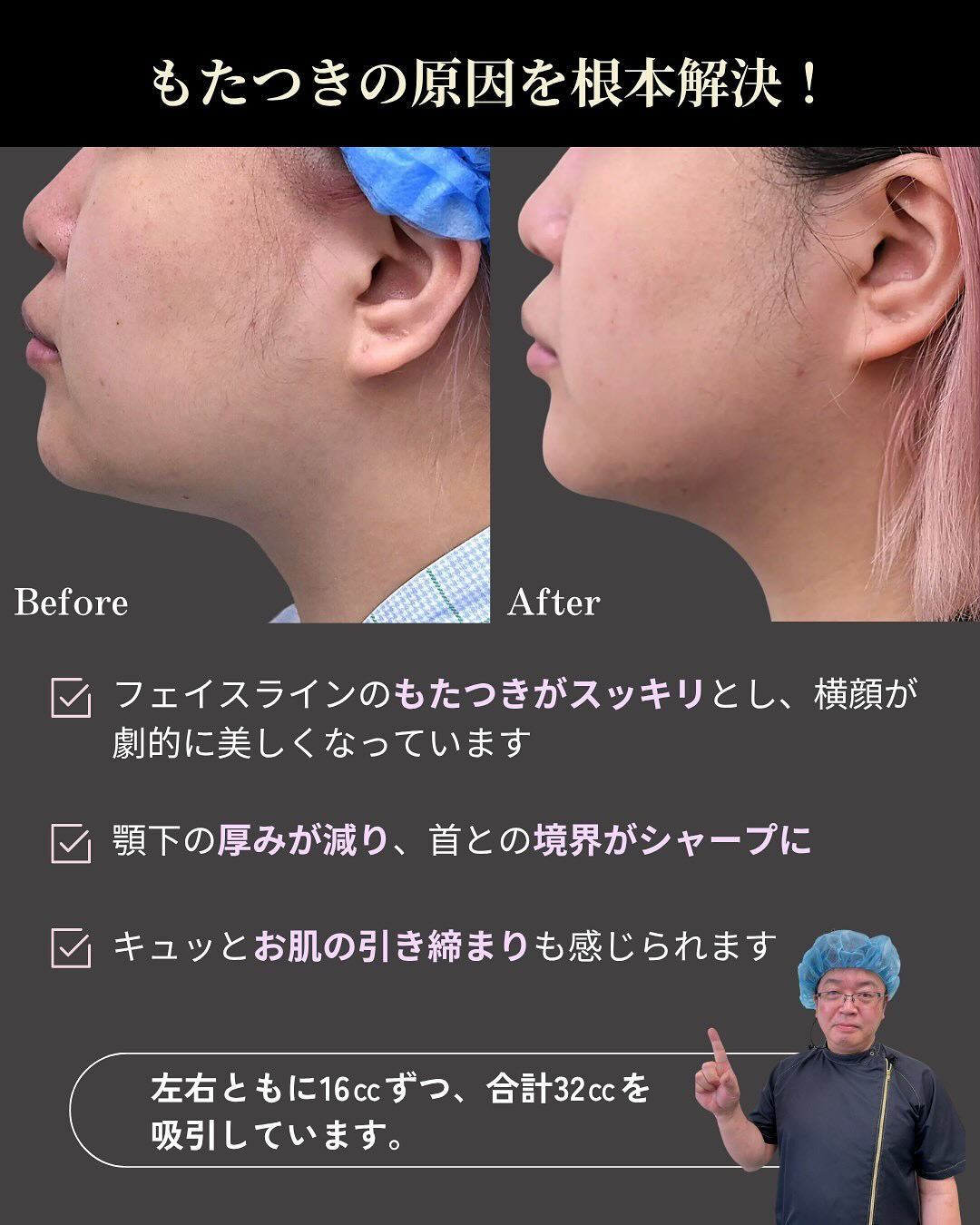 【頬・顎下脂肪吸引】