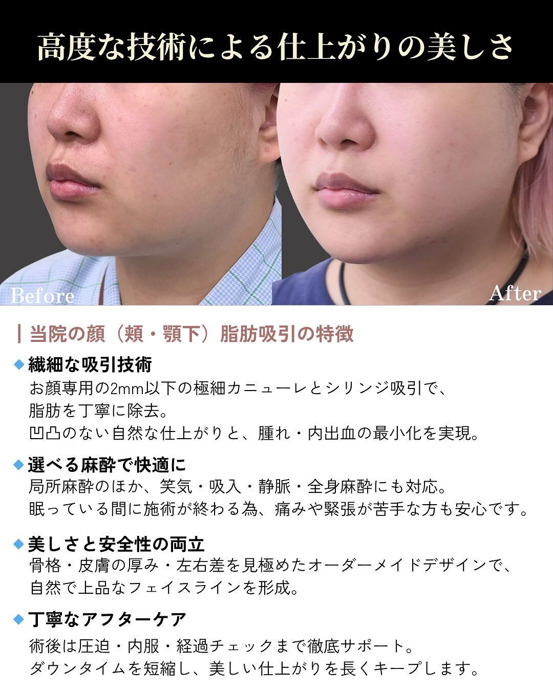 【頬・顎下脂肪吸引】