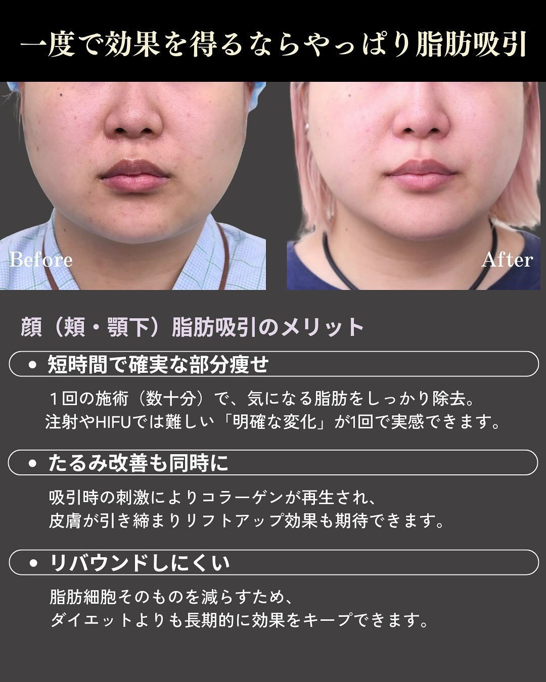 【頬・顎下脂肪吸引】