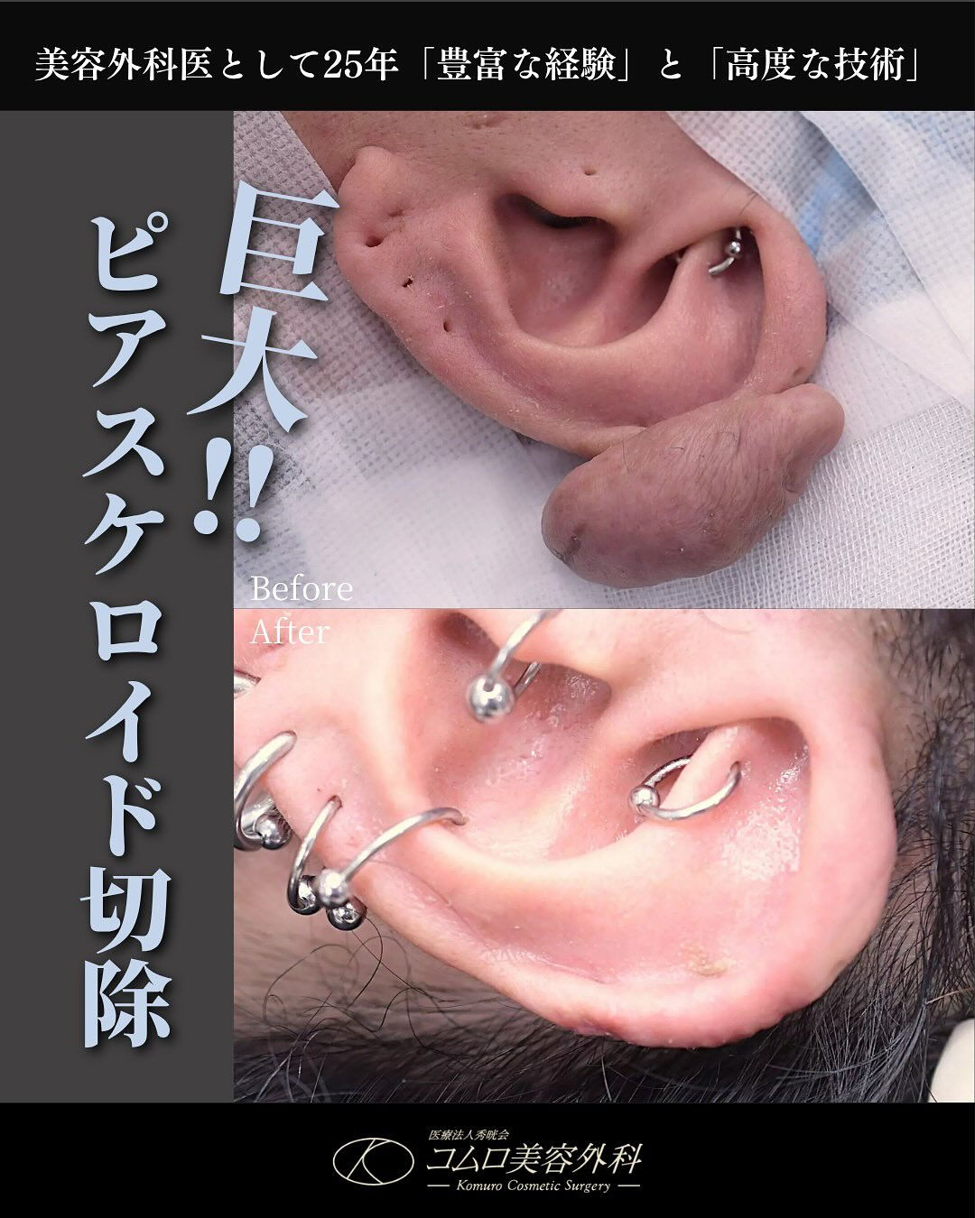 【ピアスケロイド症例】