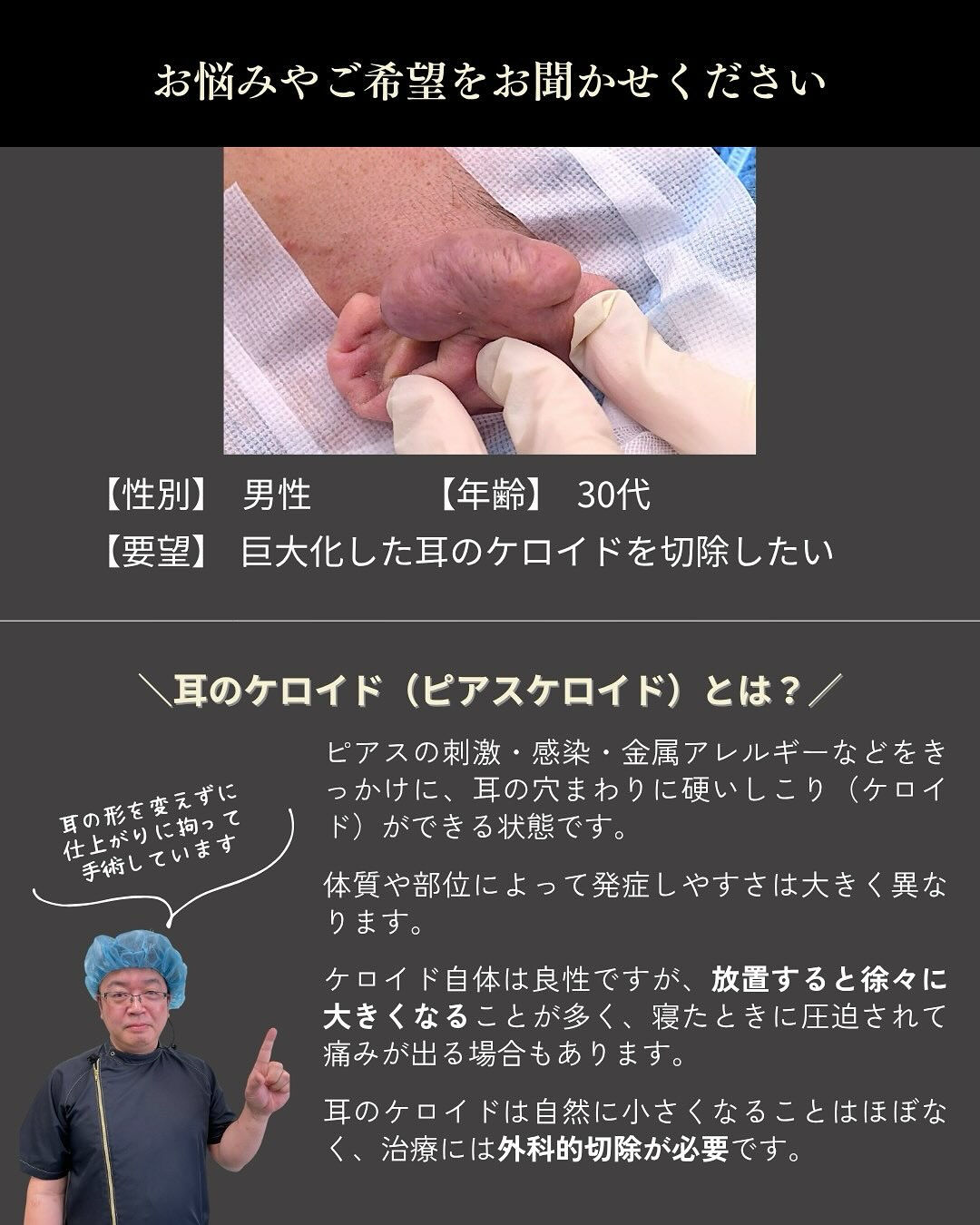 【ピアスケロイド症例】