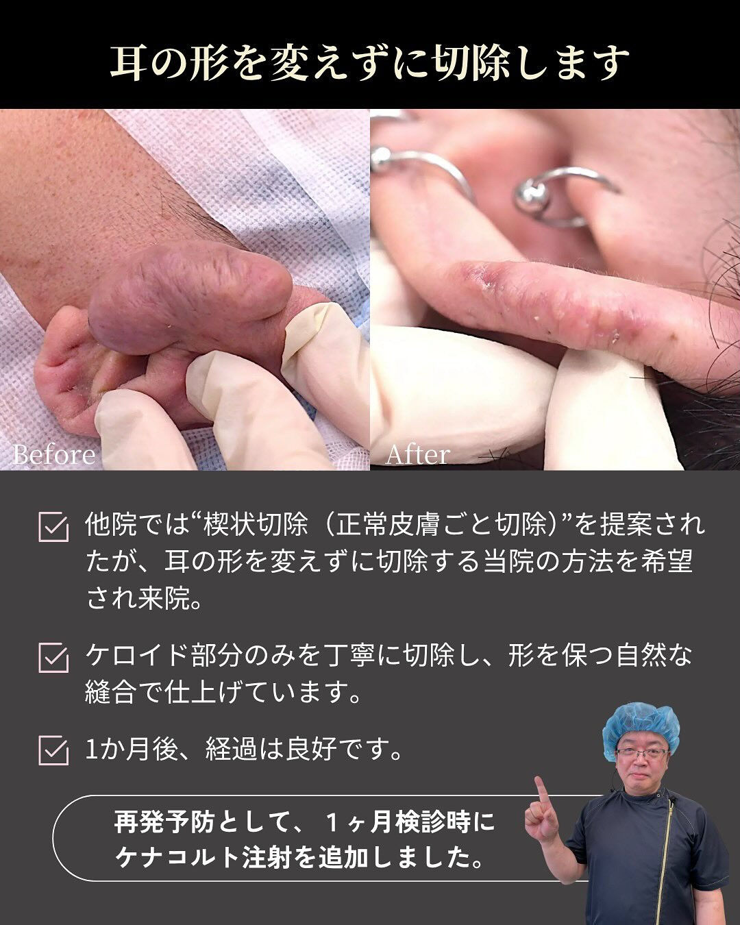 【ピアスケロイド症例】