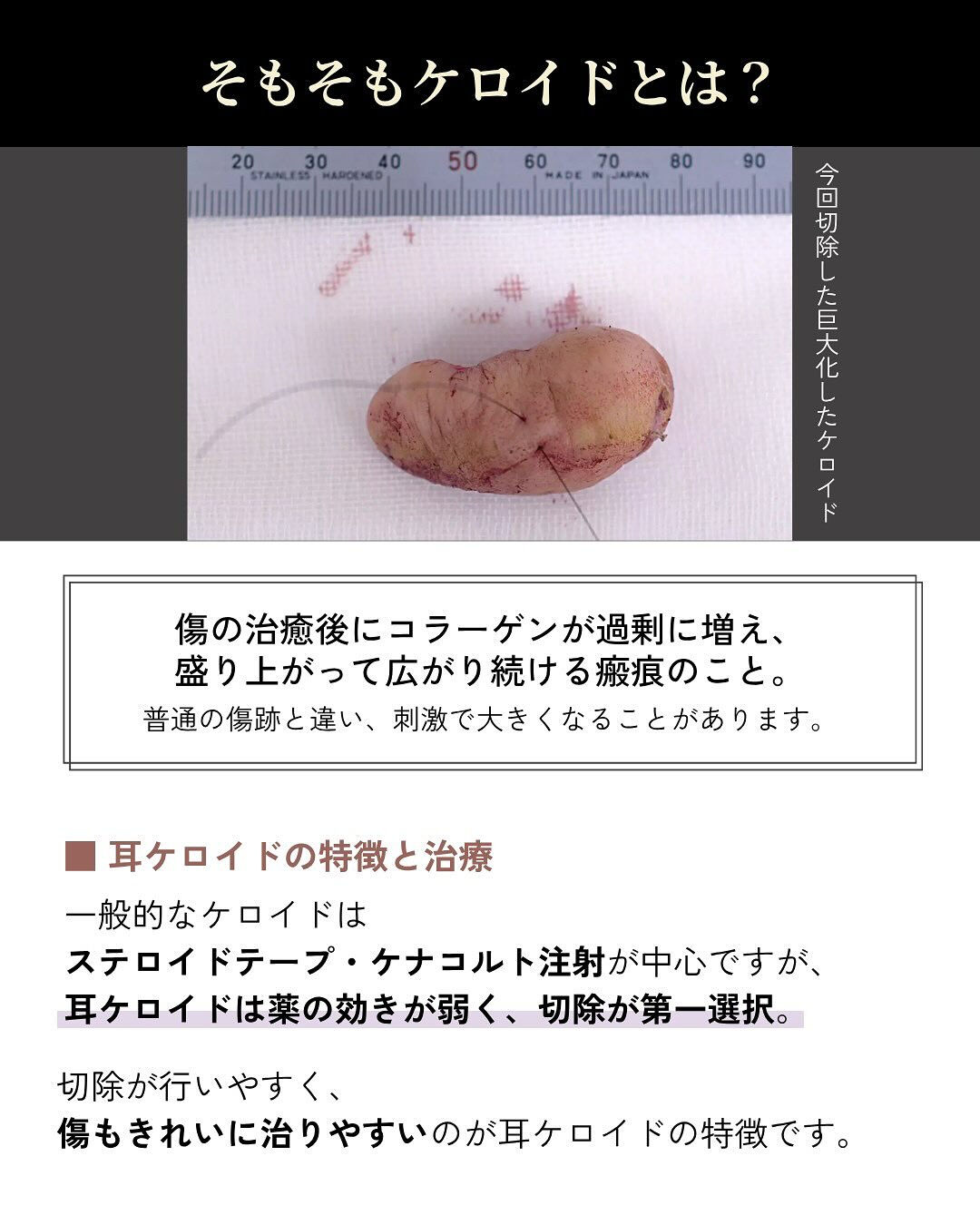 【ピアスケロイド症例】