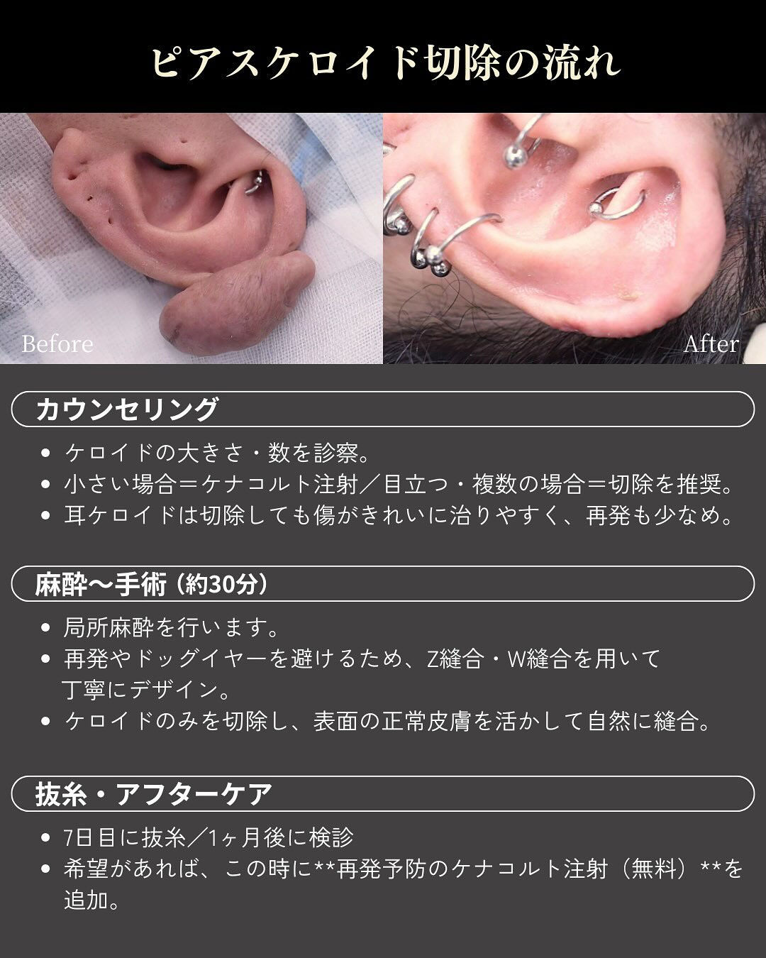 【ピアスケロイド症例】