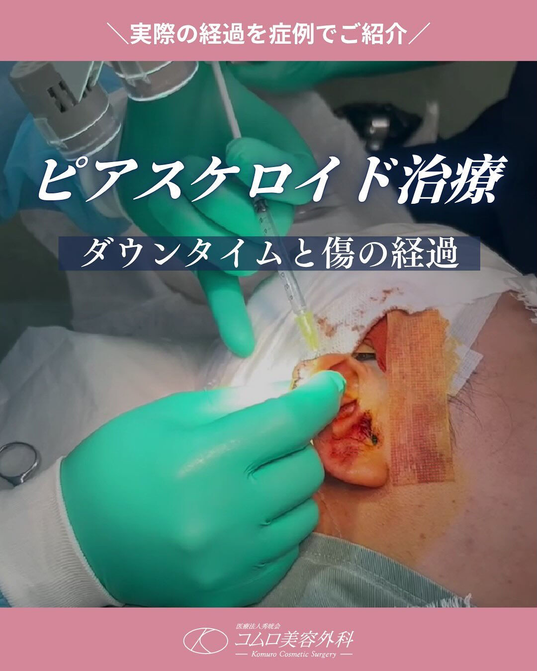 ピアスケロイド治療の気になるダウンタイムは？！