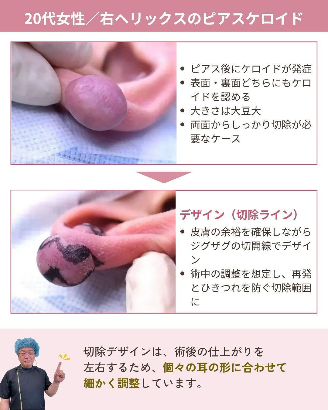 ピアスケロイド治療の気になるダウンタイムは？！