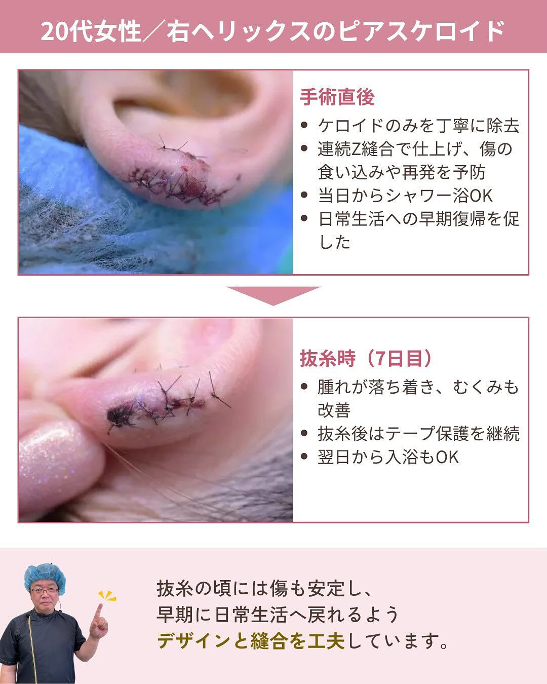 ピアスケロイド治療の気になるダウンタイムは？！