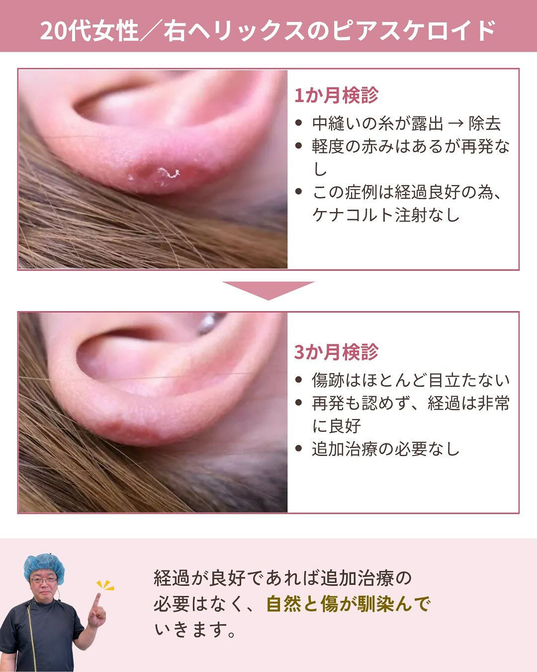 ピアスケロイド治療の気になるダウンタイムは？！