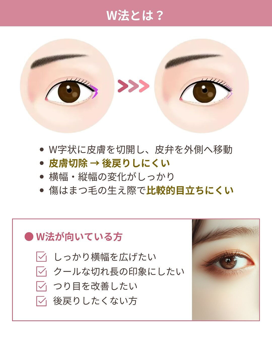 目尻切開は、
