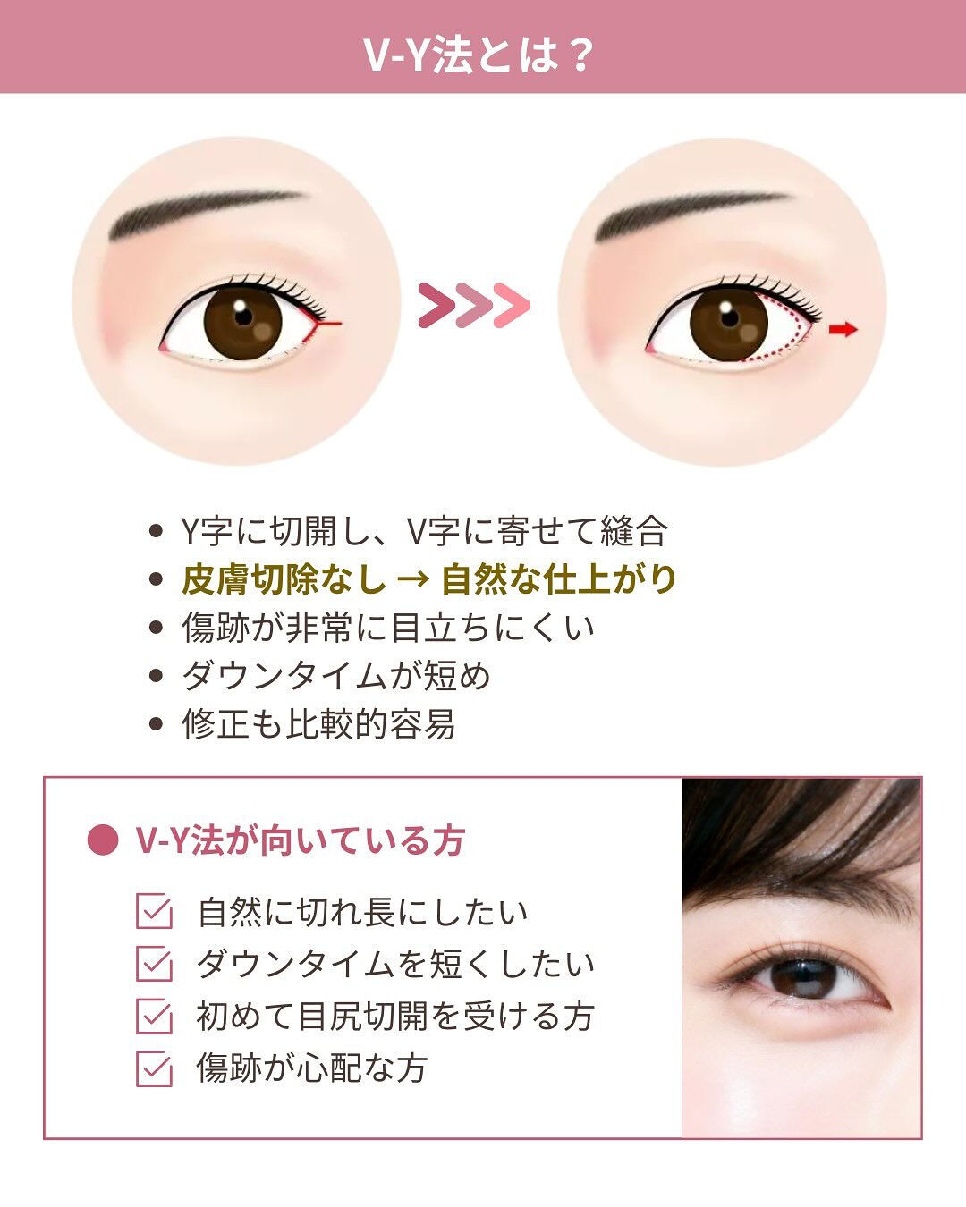 目尻切開は、
