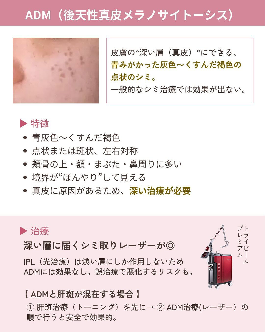 そのシミ、本当に同じ治療でいい？