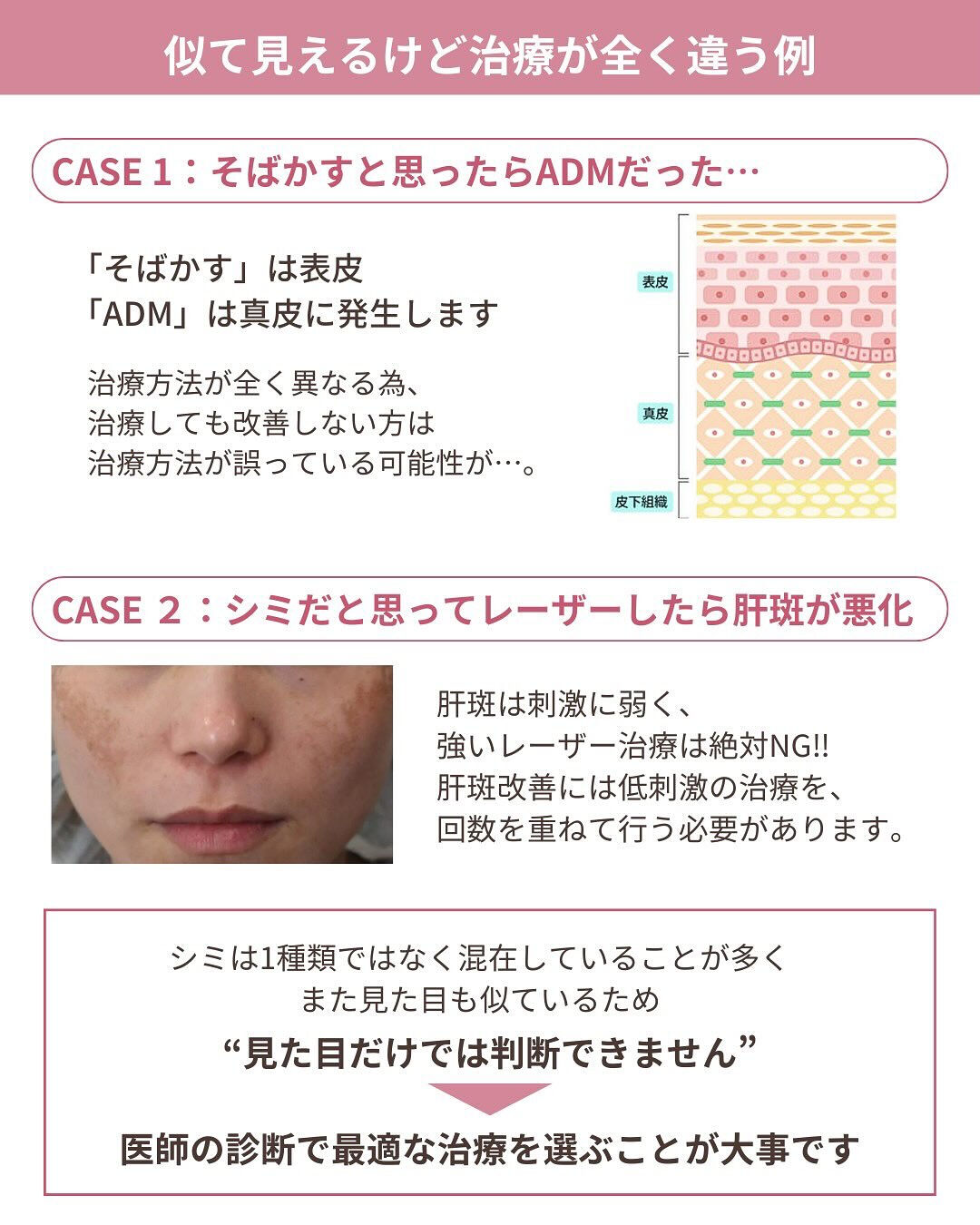 そのシミ、本当に同じ治療でいい？