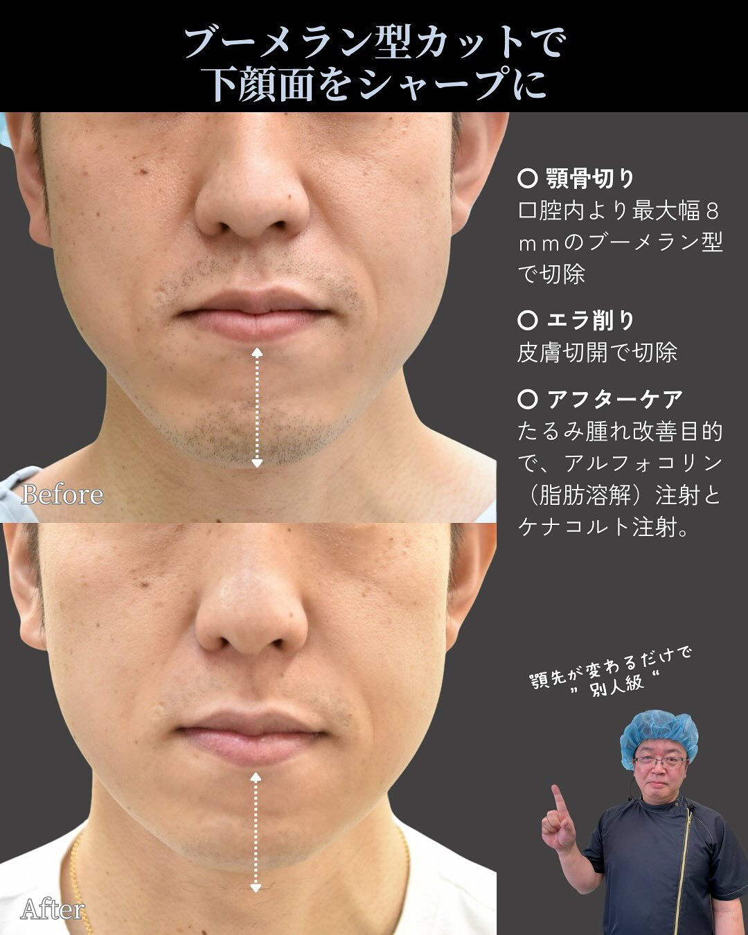 顎骨切り+エラ削り症例✨