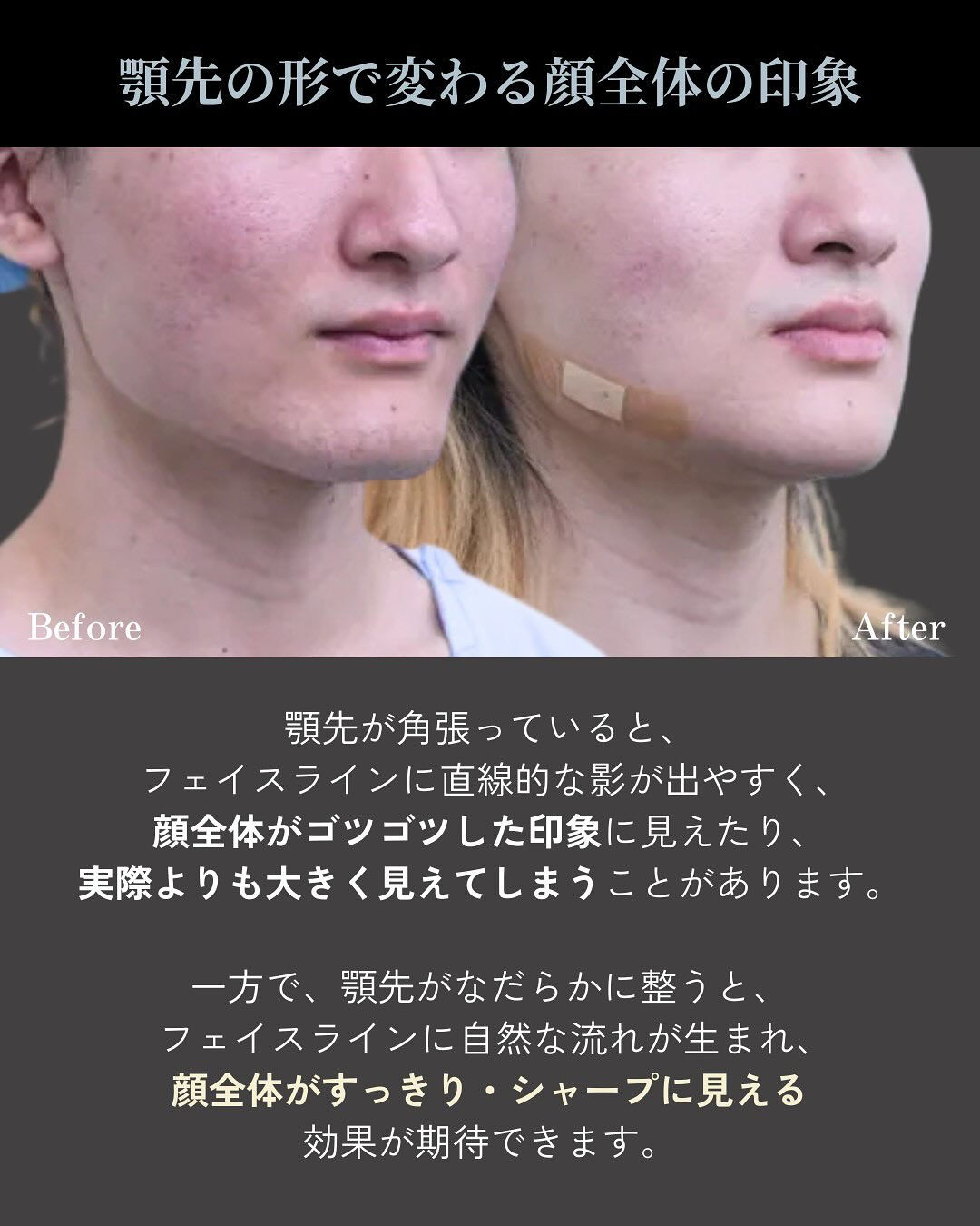 お顔の印象を大きく左右する「顎のライン」
