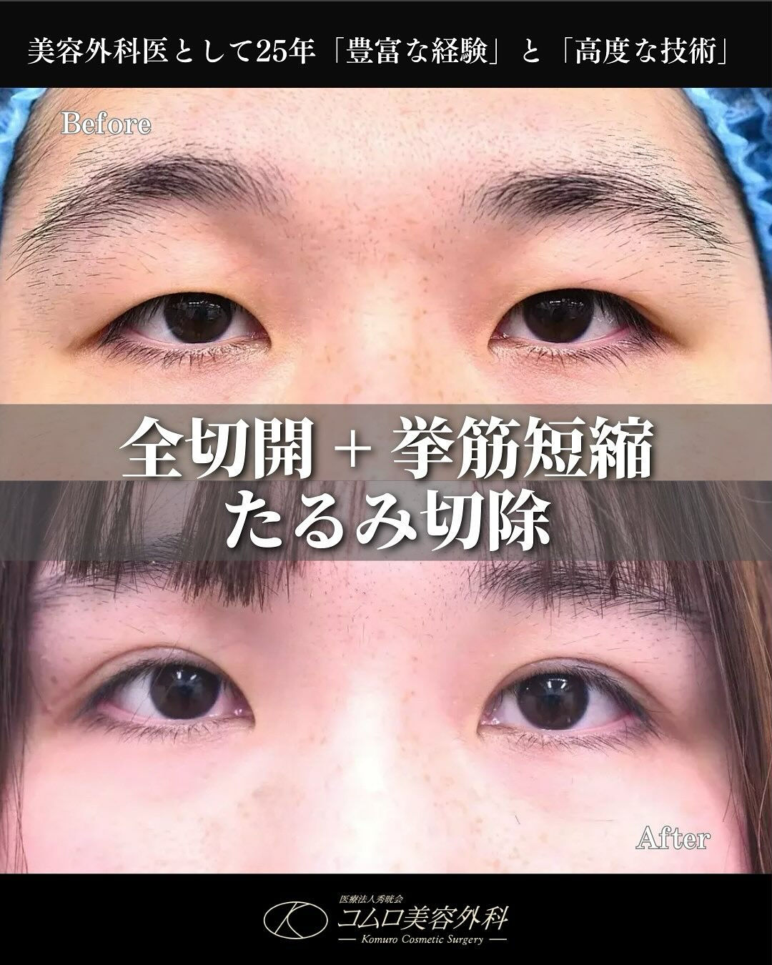 全切開＋挙筋短縮＋たるみ切除症例