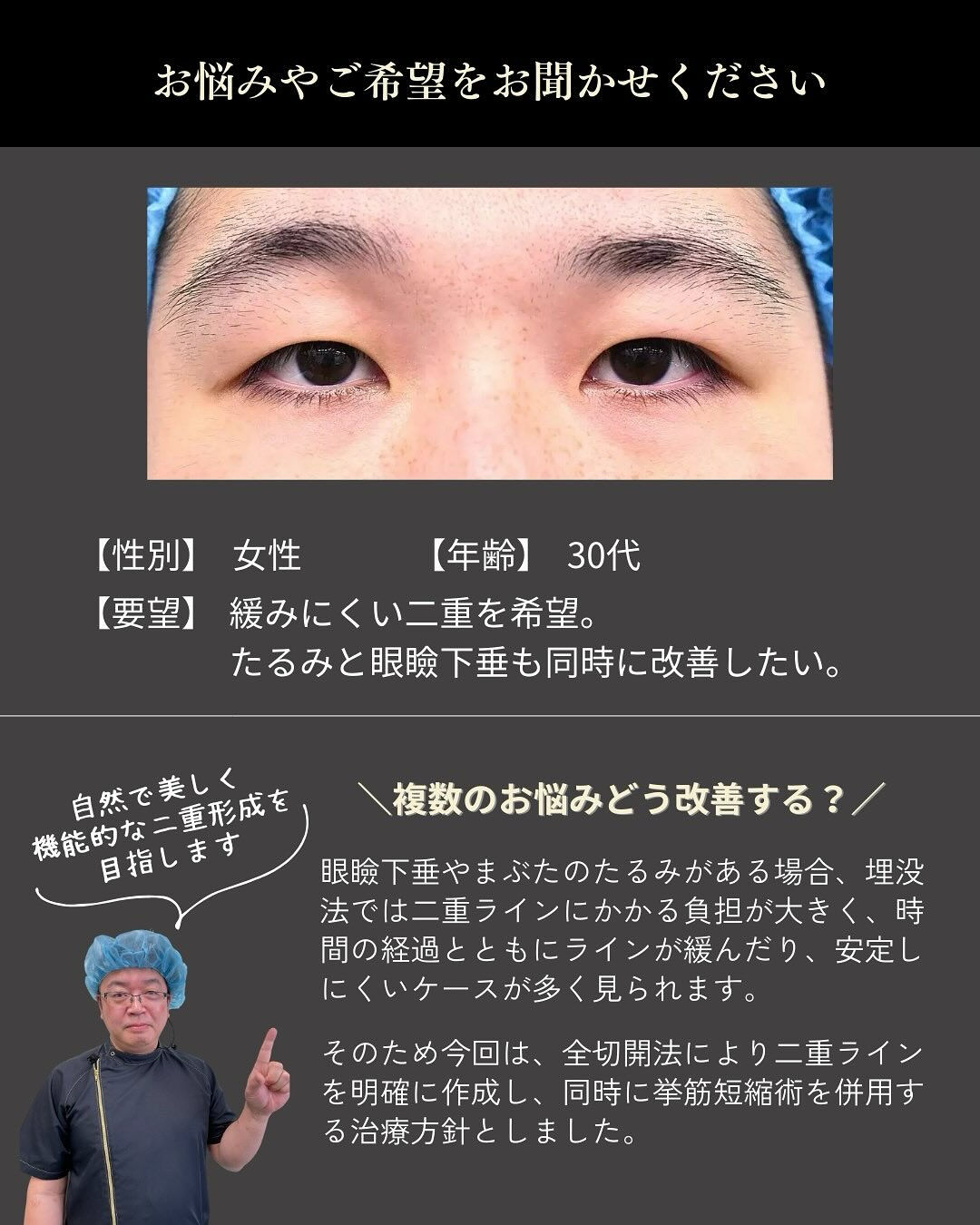 全切開＋挙筋短縮＋たるみ切除症例