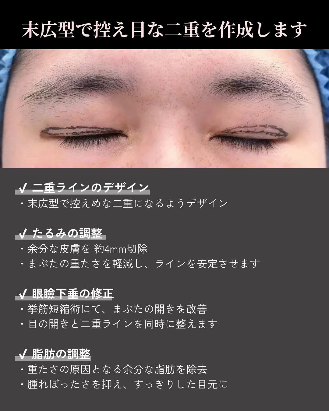 全切開＋挙筋短縮＋たるみ切除症例
