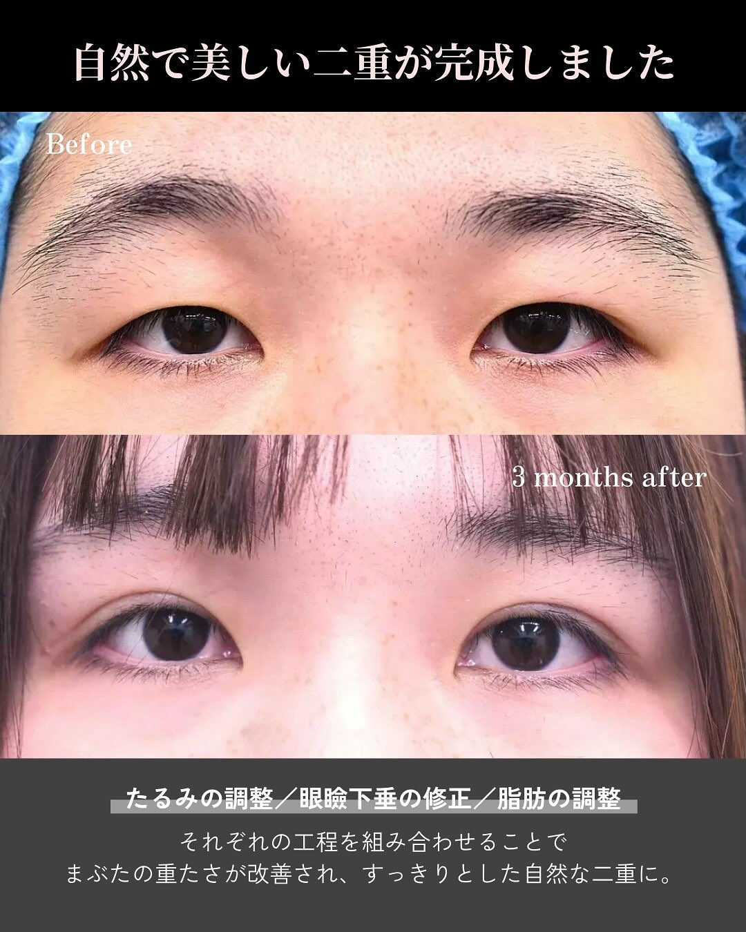 全切開＋挙筋短縮＋たるみ切除症例