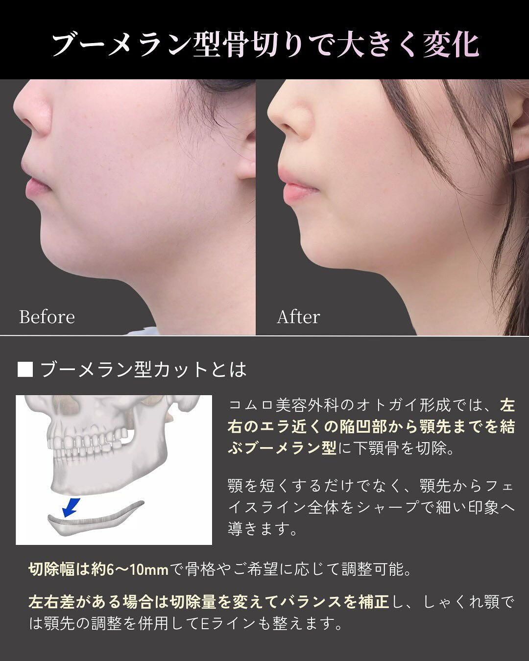 顎を細く短くしたい！