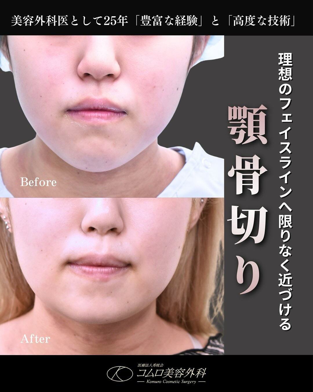 20代女性の下顎骨骨切り症例です👨‍⚕️