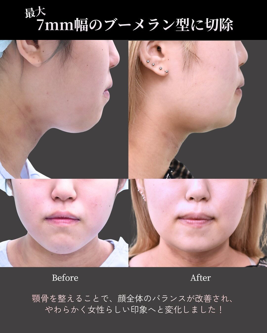 20代女性の下顎骨骨切り症例です👨‍⚕️