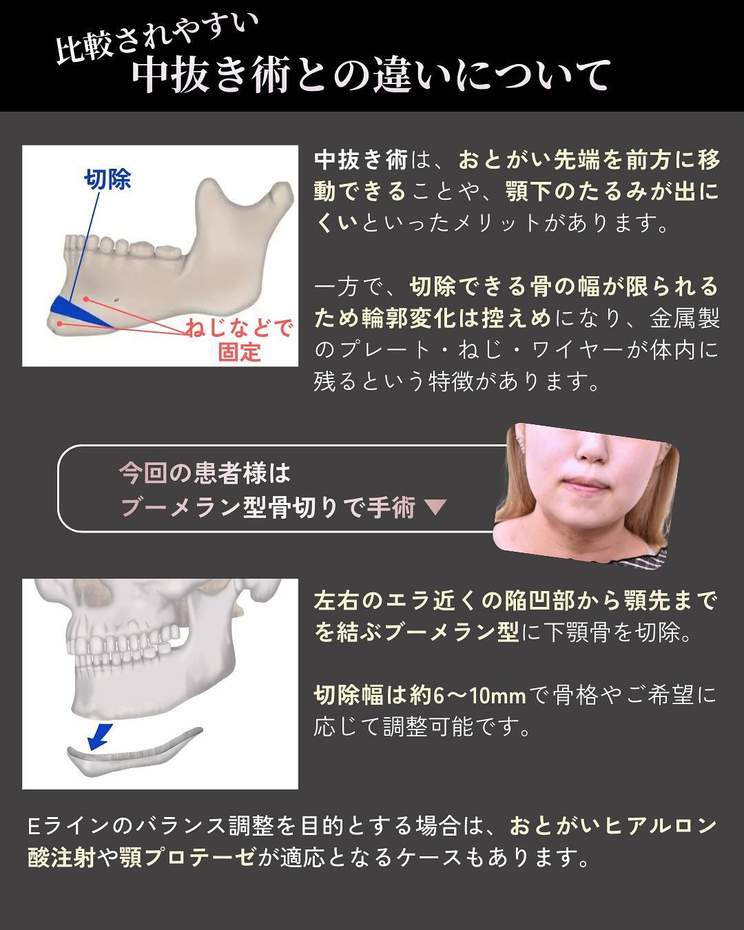 20代女性の下顎骨骨切り症例です👨‍⚕️