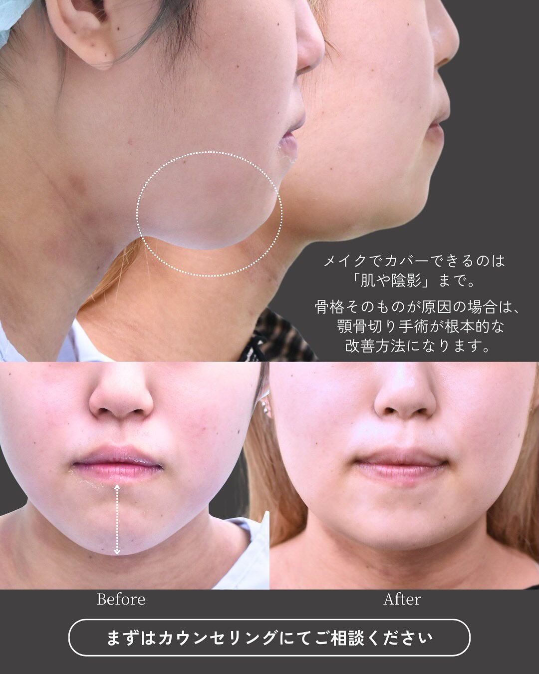 20代女性の下顎骨骨切り症例です👨‍⚕️