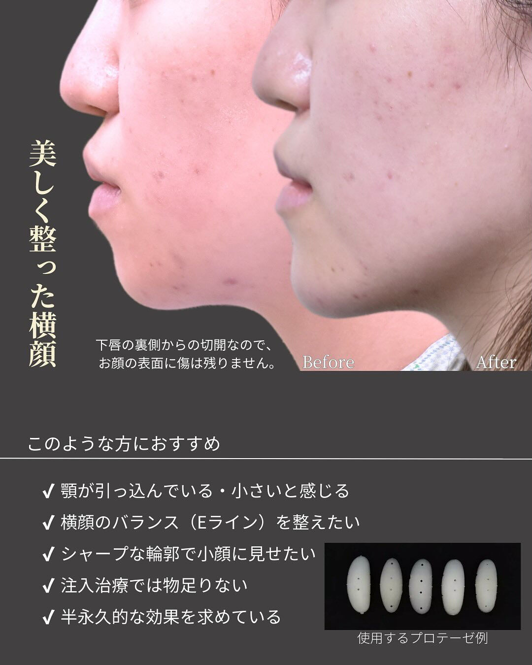 下顎形成症例👨‍⚕️