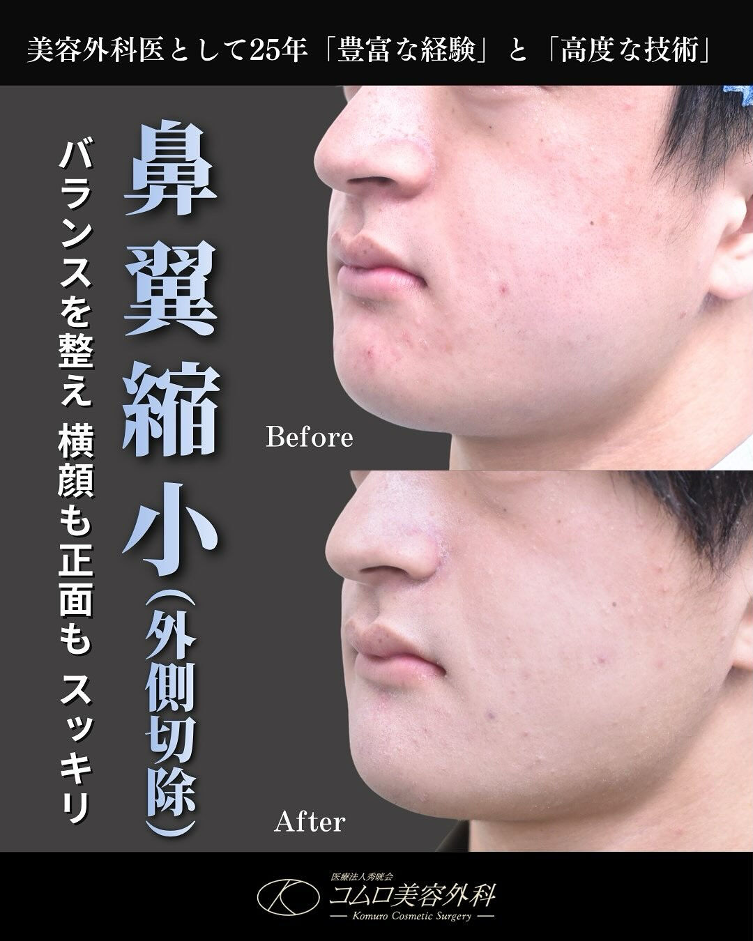 小鼻の横幅や広がりが気になる方へ