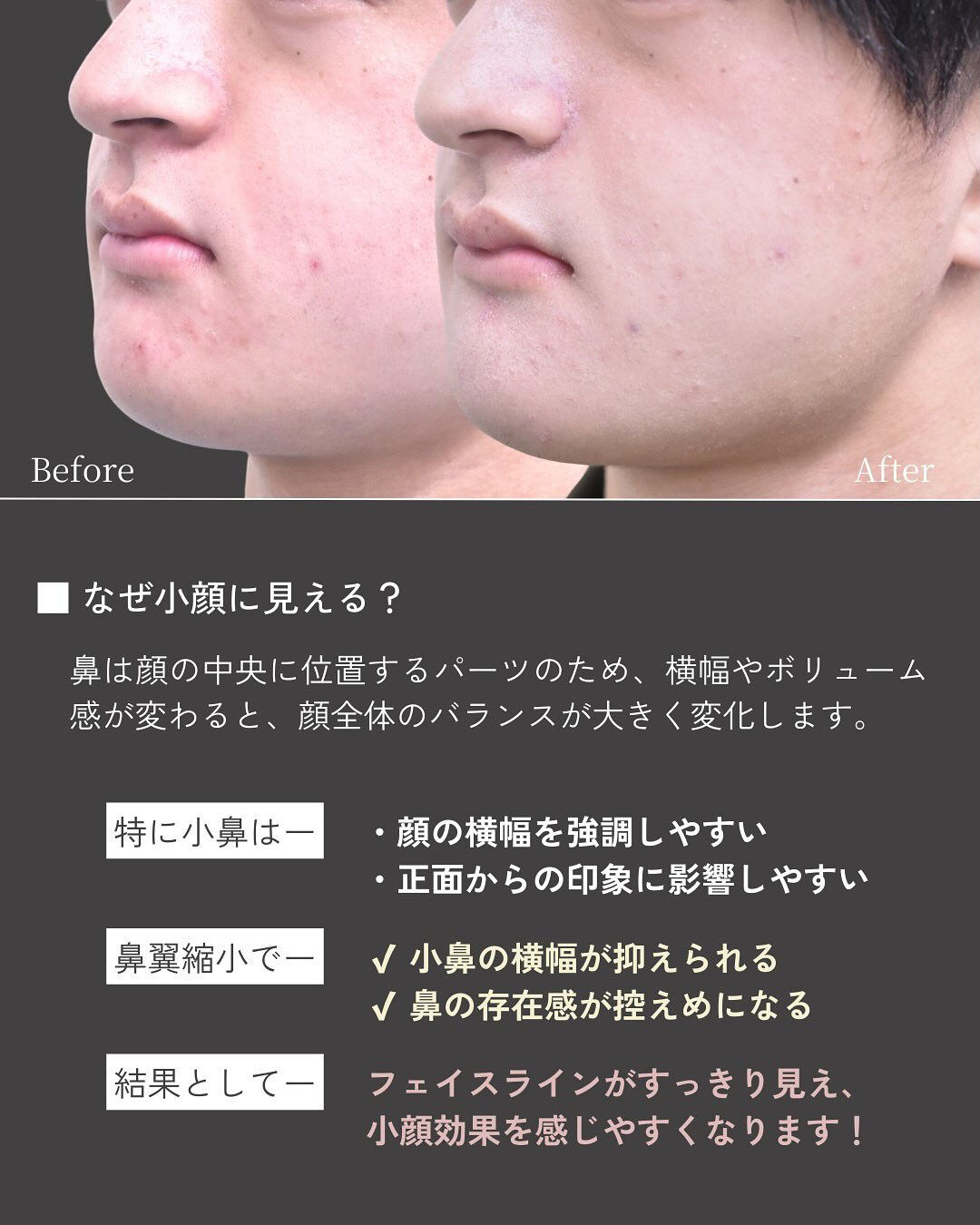 小鼻の横幅や広がりが気になる方へ