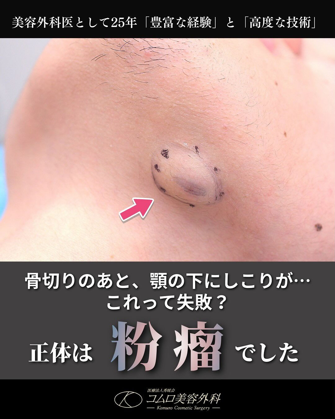 「先生、骨切りをした顎の下に、コリコリしたしこりができました