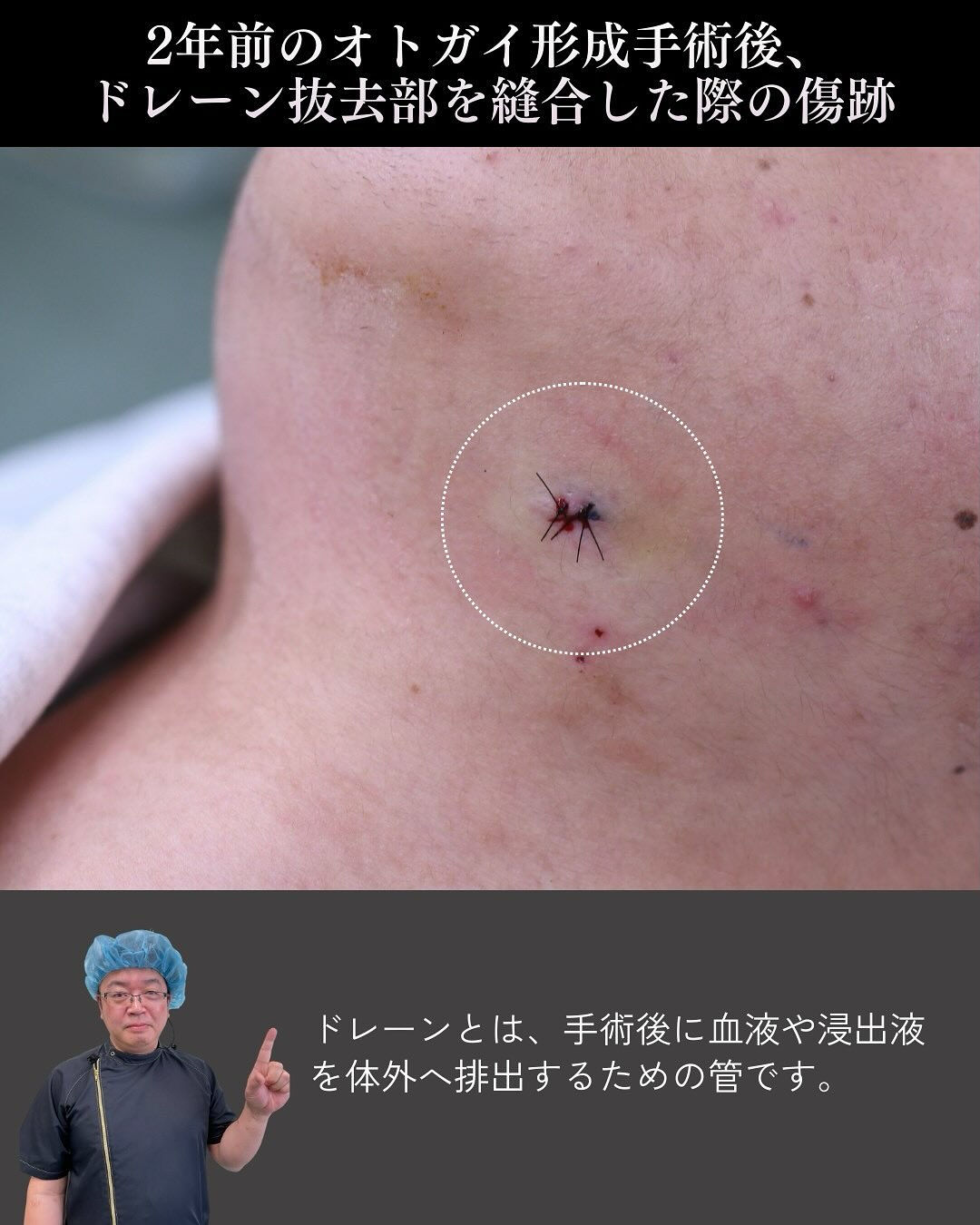 「先生、骨切りをした顎の下に、コリコリしたしこりができました