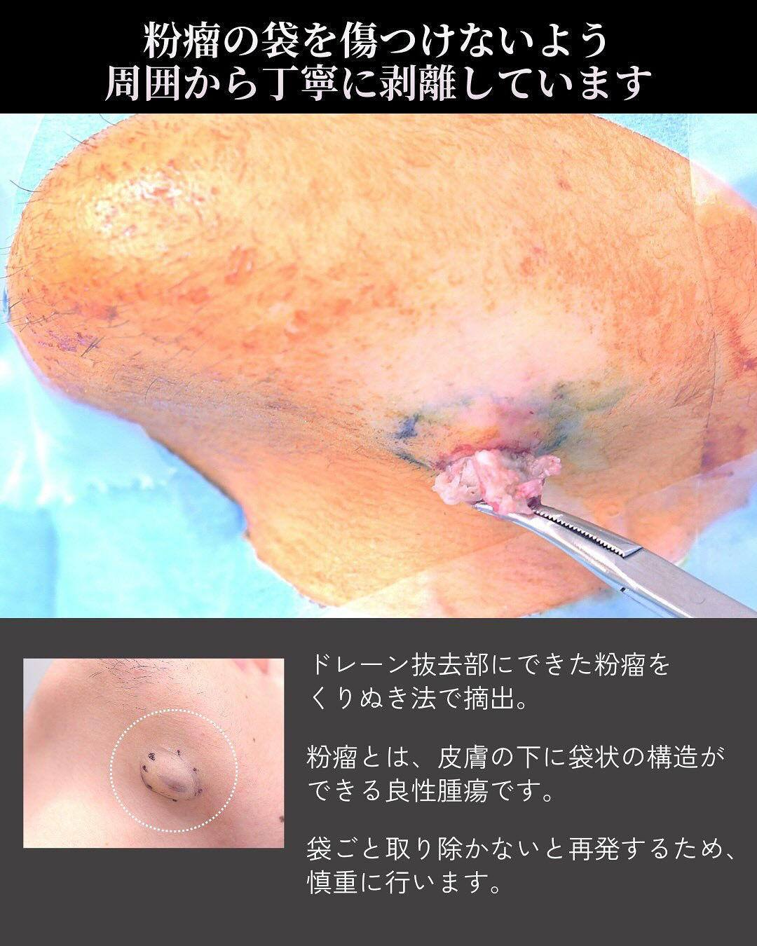 「先生、骨切りをした顎の下に、コリコリしたしこりができました