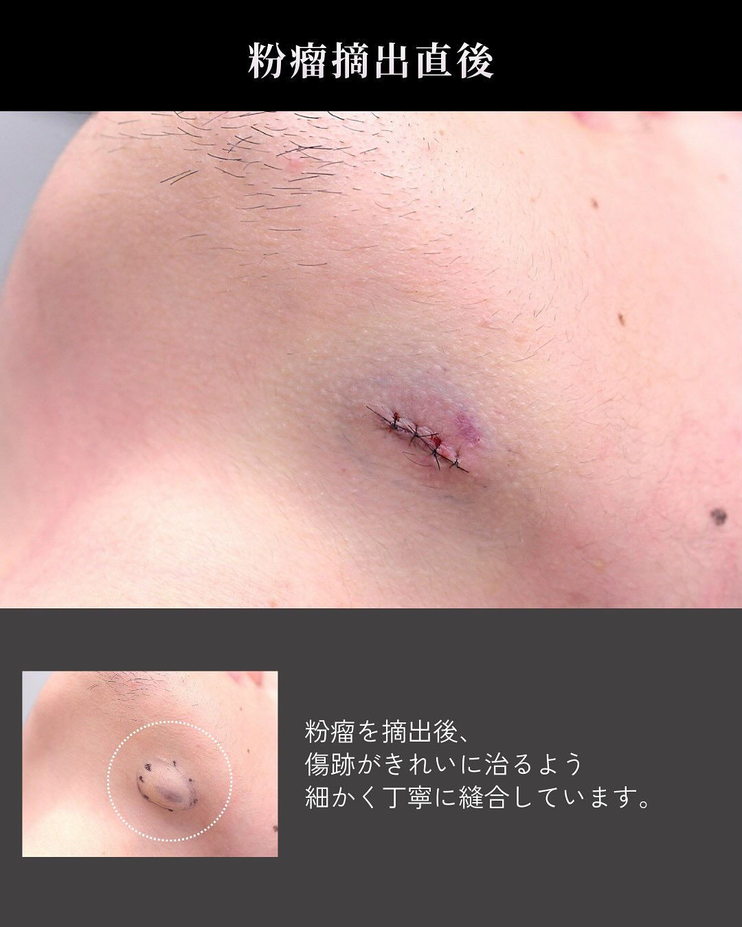 「先生、骨切りをした顎の下に、コリコリしたしこりができました