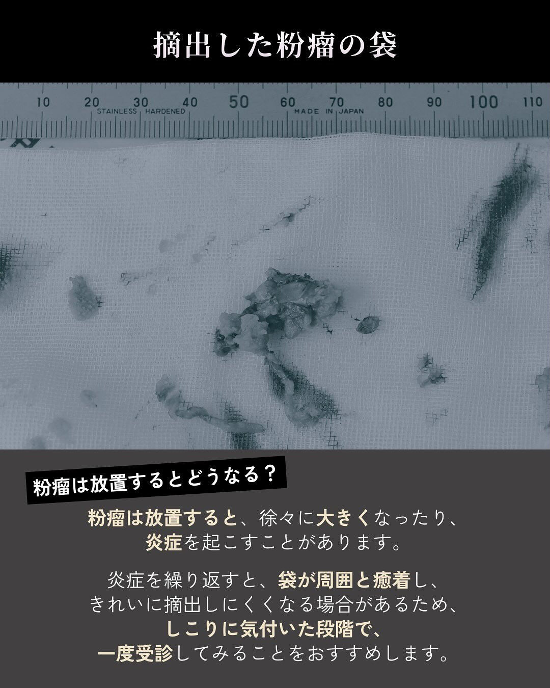 「先生、骨切りをした顎の下に、コリコリしたしこりができました