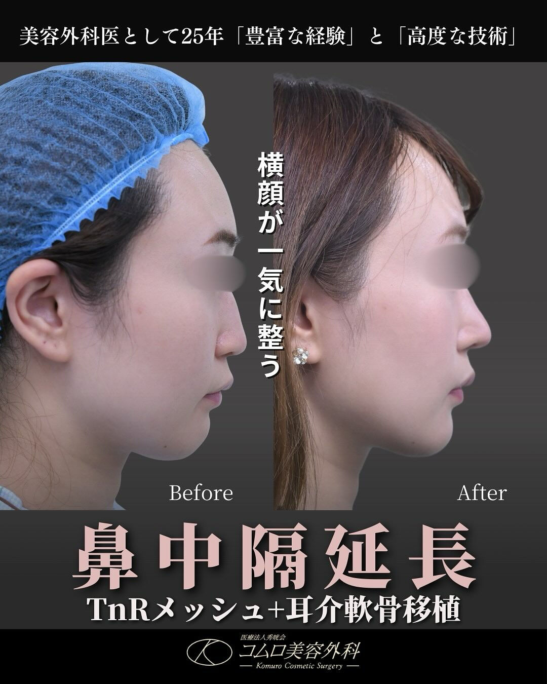 「鼻を高くしたい」というお悩みでも、