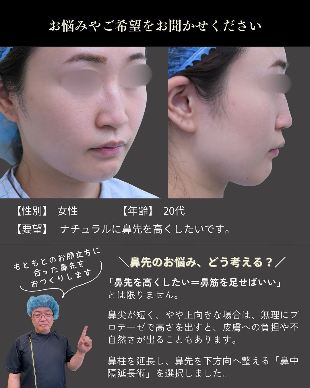 「鼻を高くしたい」というお悩みでも、