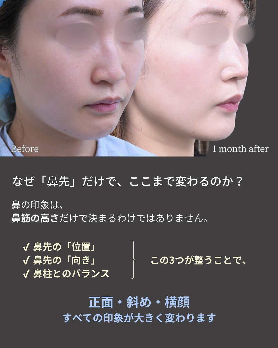 「鼻を高くしたい」というお悩みでも、