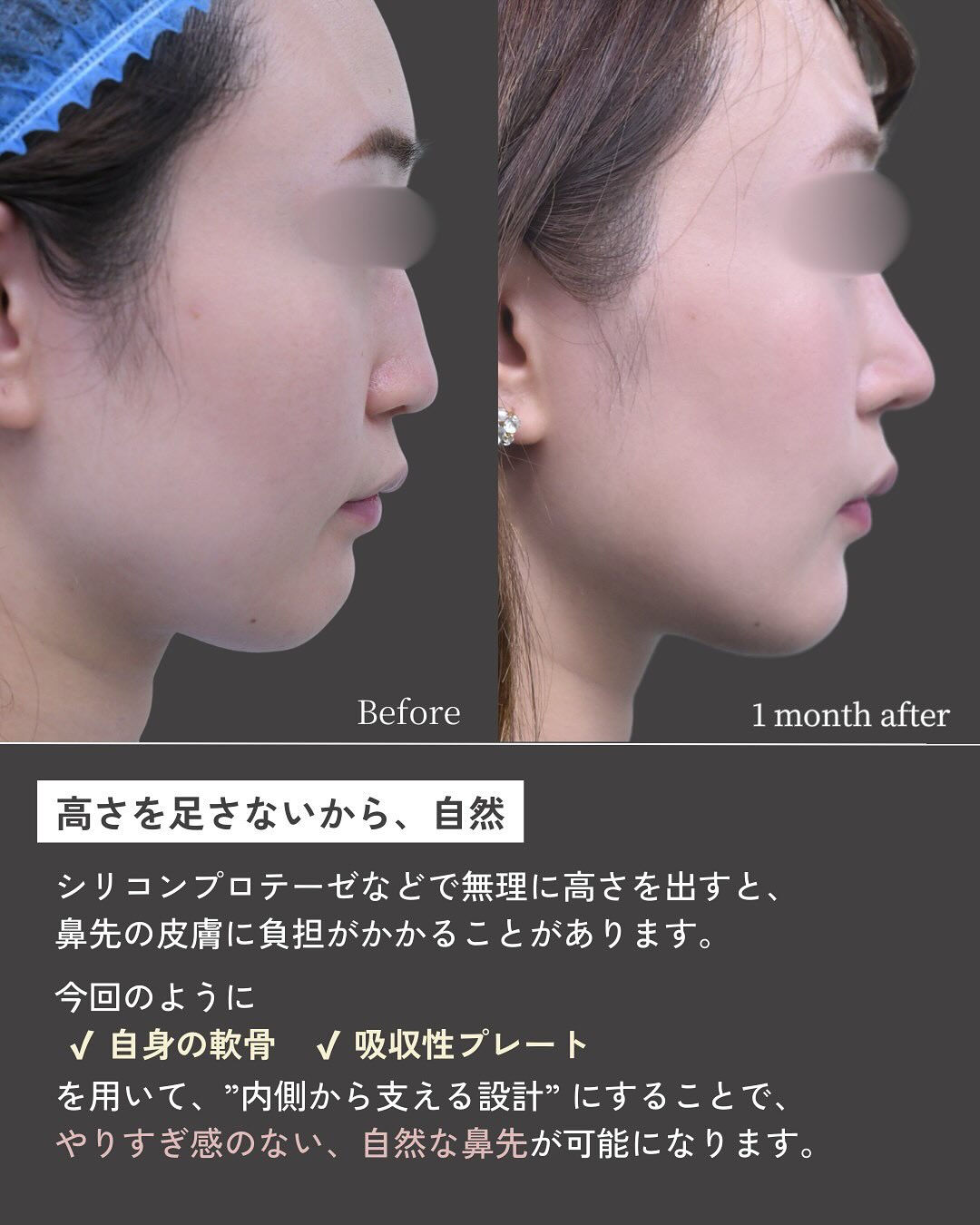 「鼻を高くしたい」というお悩みでも、