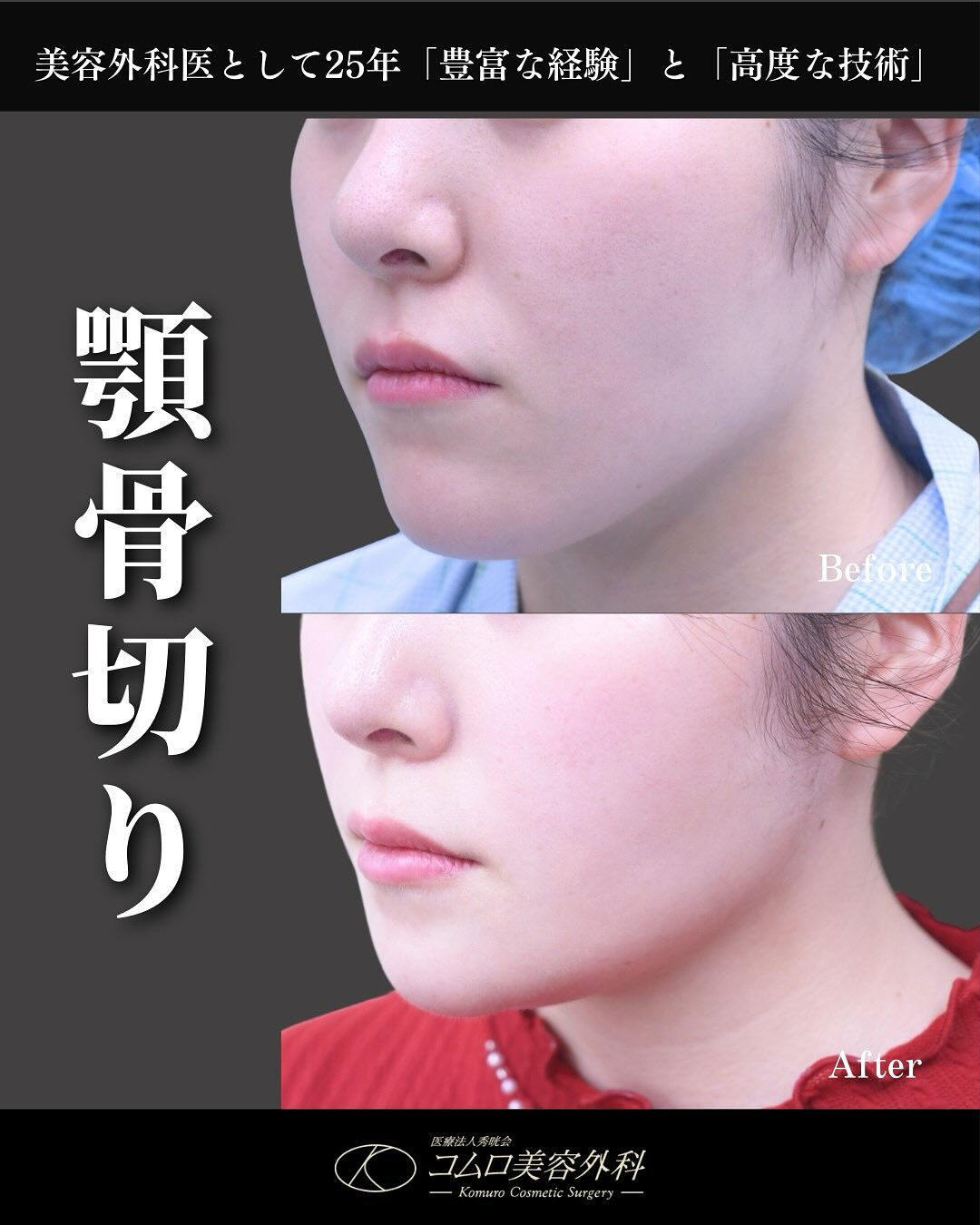 顎の長さは、顔全体の印象を大きく左右する重要なパーツです
