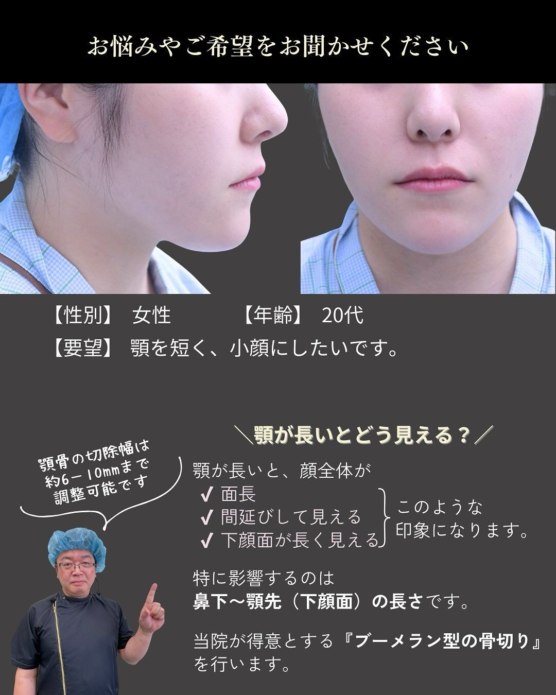顎の長さは、顔全体の印象を大きく左右する重要なパーツです