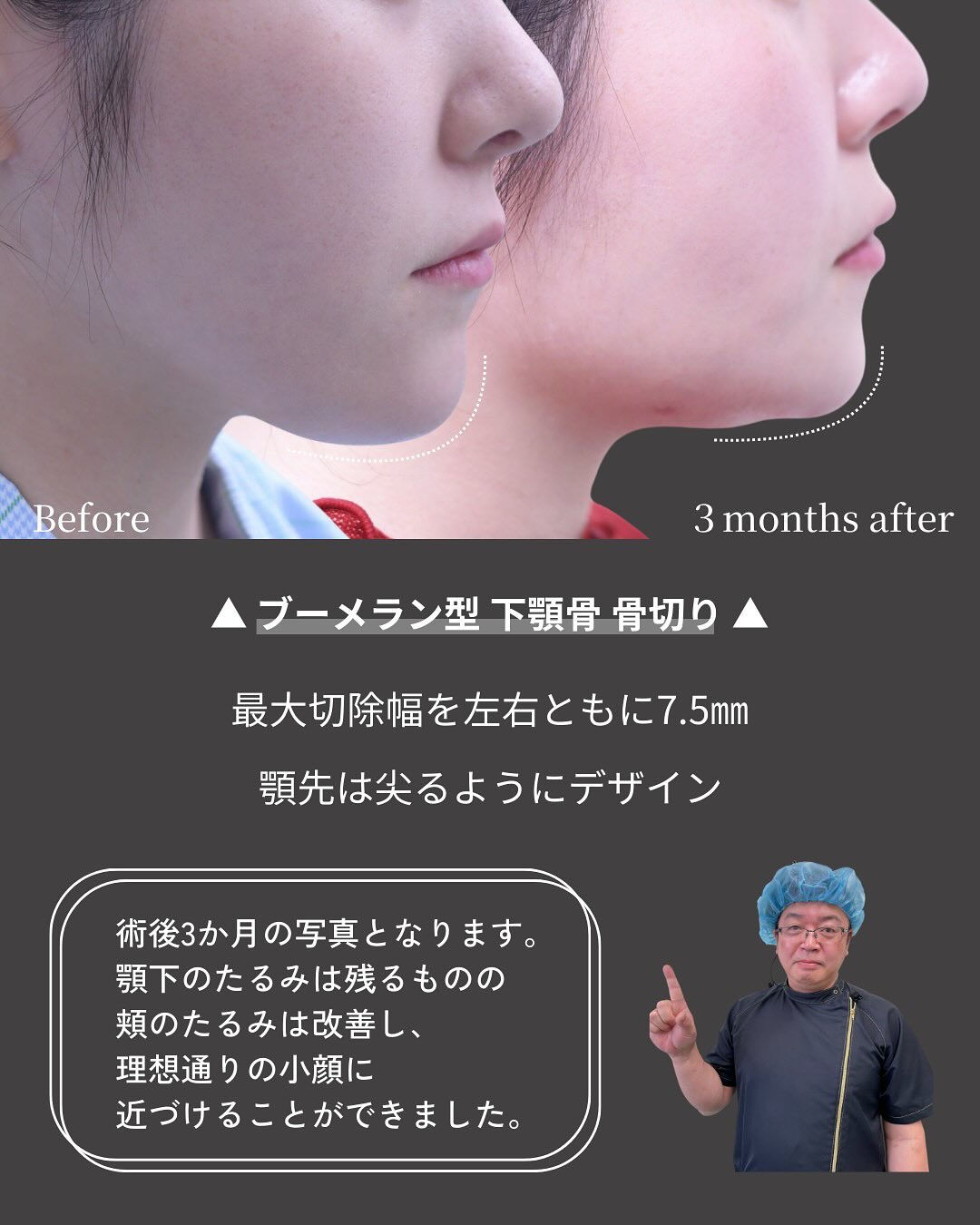 顎の長さは、顔全体の印象を大きく左右する重要なパーツです