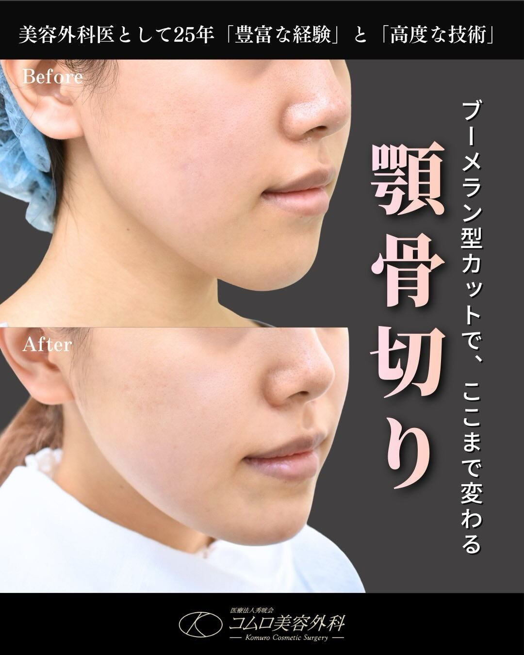 顎の長さや形は、顔全体のバランスを大きく左右する重要な要素で