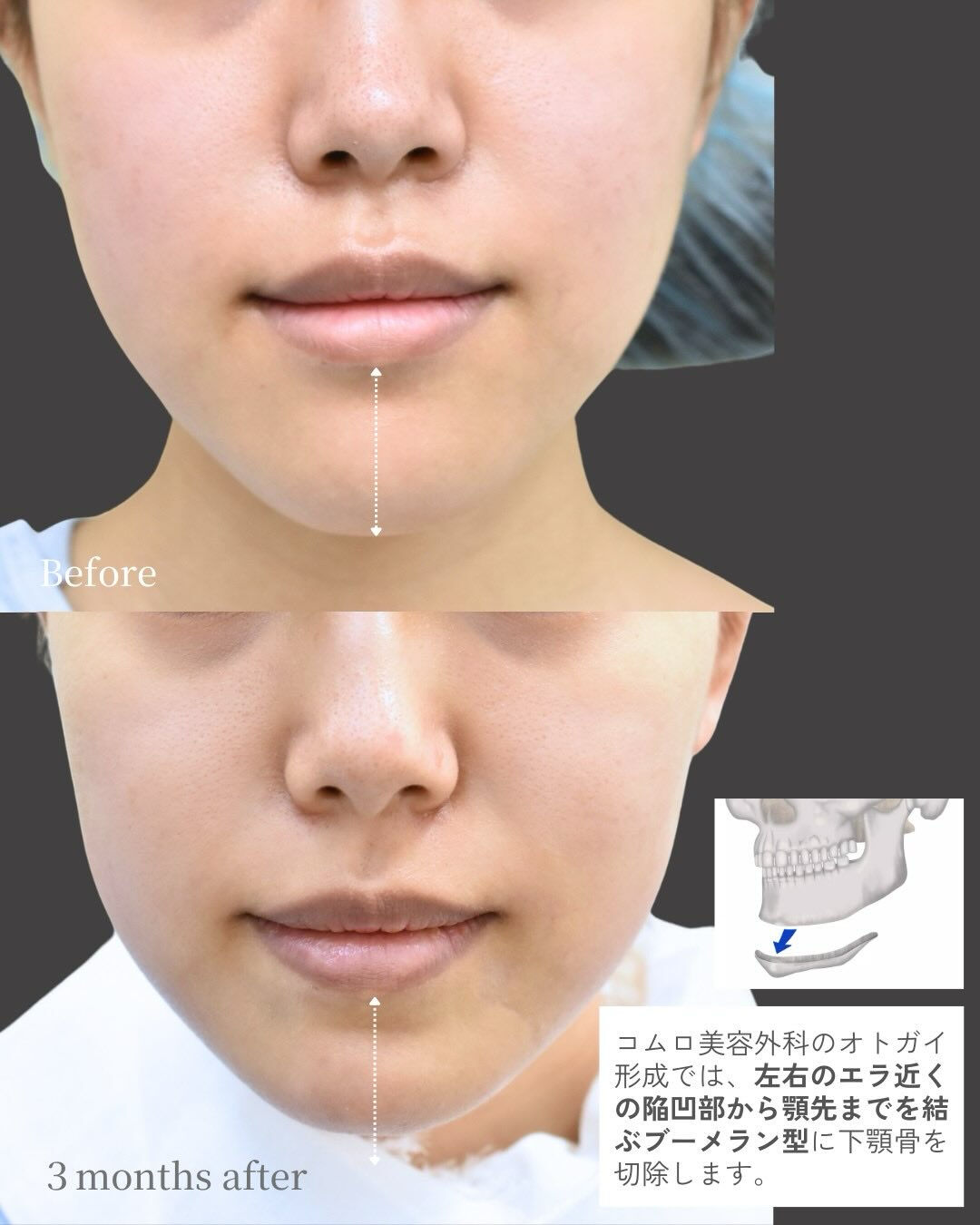 顎の長さや形は、顔全体のバランスを大きく左右する重要な要素で