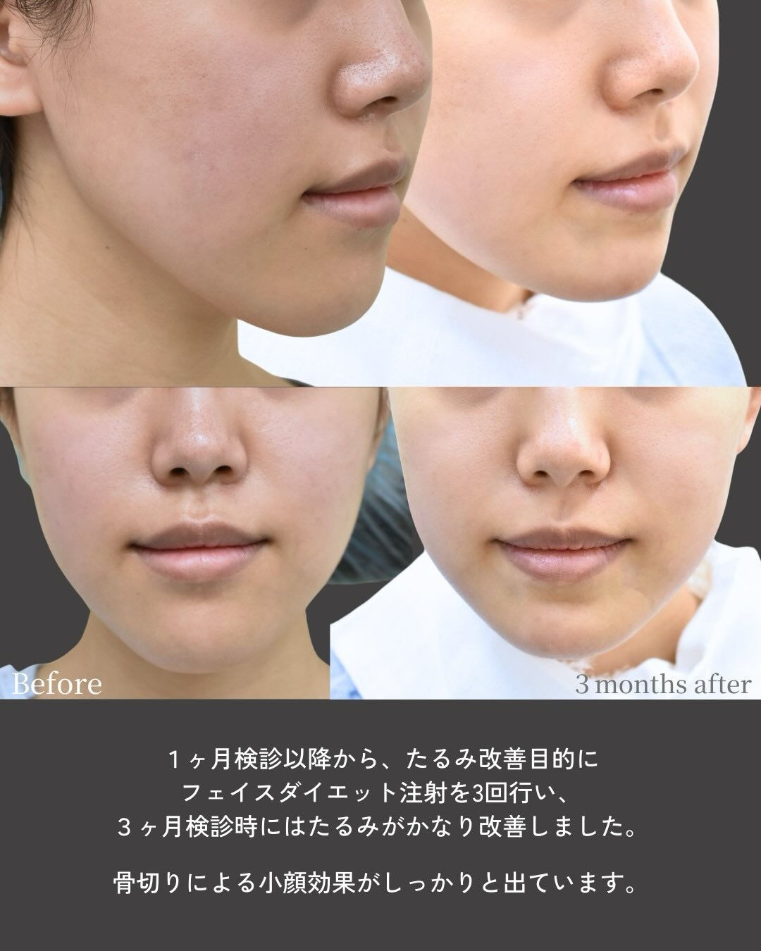 顎の長さや形は、顔全体のバランスを大きく左右する重要な要素で