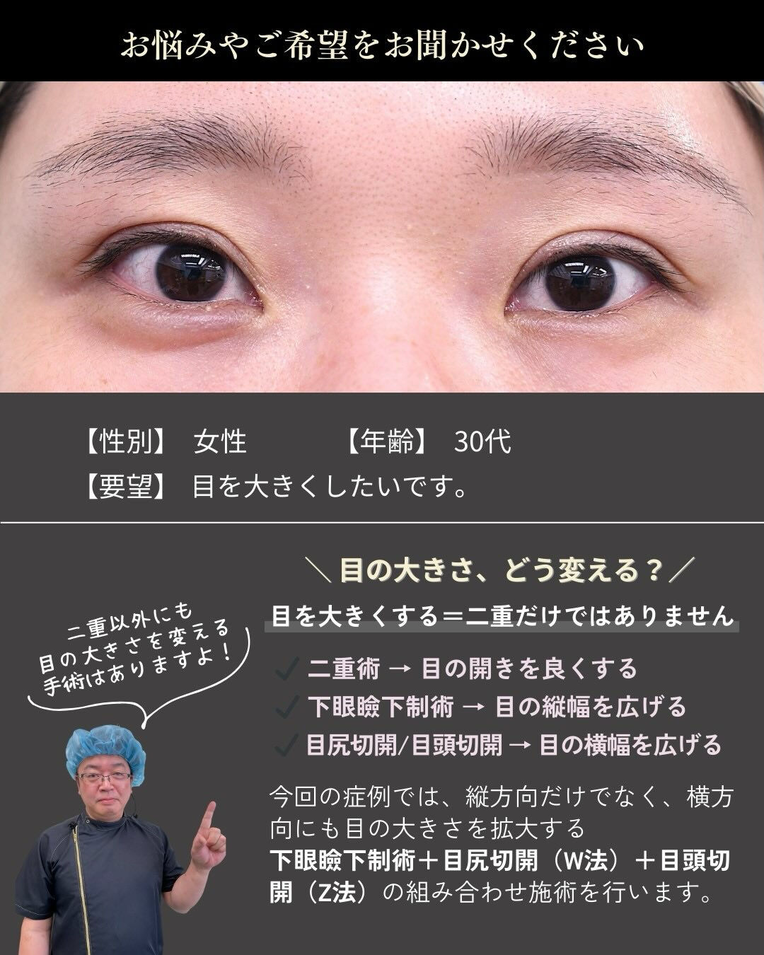 目を大きく見せたいというご希望で、
